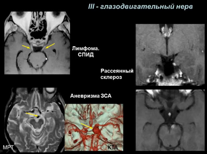 Мрт нервов. Глазодвигательный нерв анатомия мрт. Невринома зрительного нерва мрт. Блоковый нерв мрт.